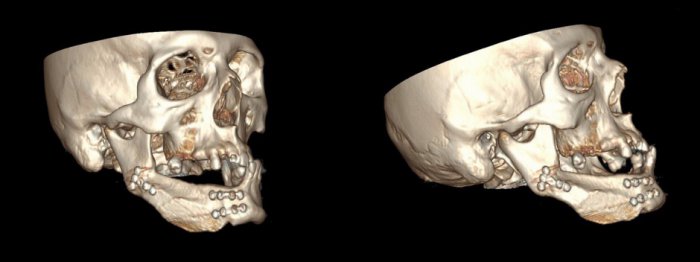 3D печать в челюстно-лицевой хирургии