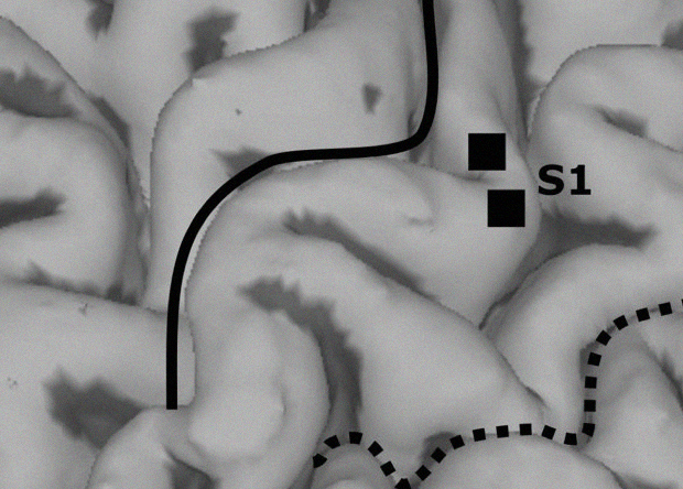 Инвазивная микростимуляция вернула тактильные ощущения парализованному пациенту