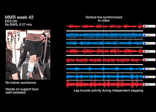Электростимуляция спинного мозга помогла пациенту с параличом заново научиться ходить